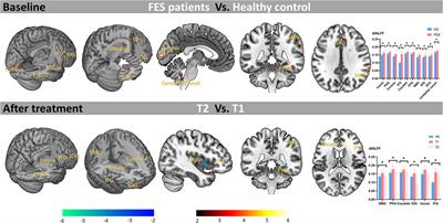 Effects of long-term antipsychotic medication on brain instability in first-episode schizophrenia patients: a resting-state fMRI study